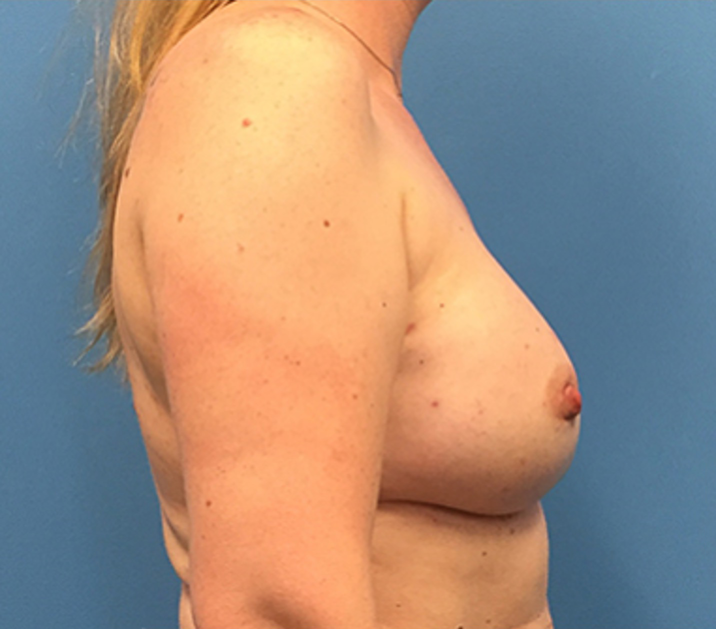 Case--138 | After Breast 2