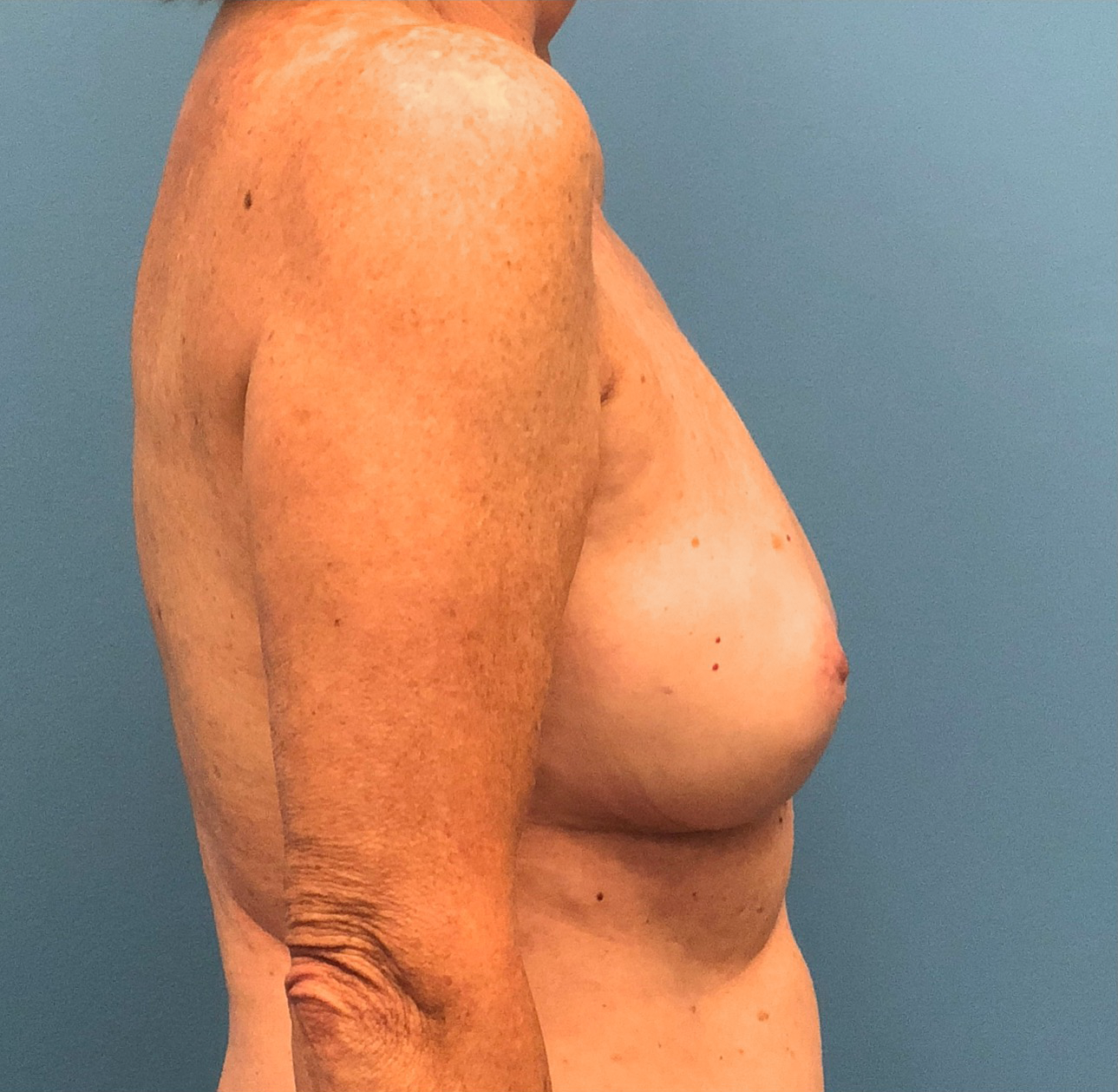 Case--13861 | After Breast 2
