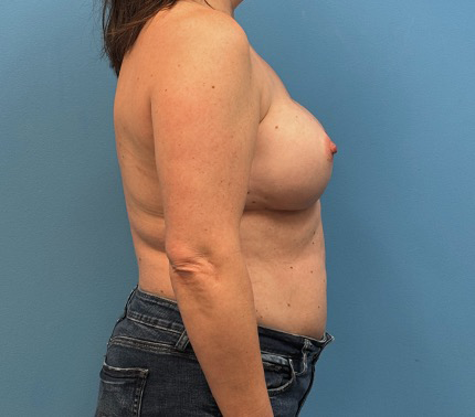 Breast-Reconstruction-Case--27065 | After Breast 2