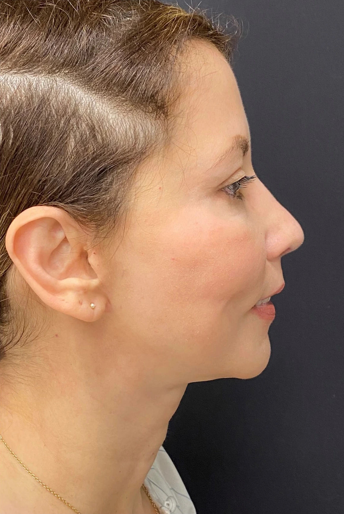 Rhinoplasty-Case--375 | After Rhinoplasty 2