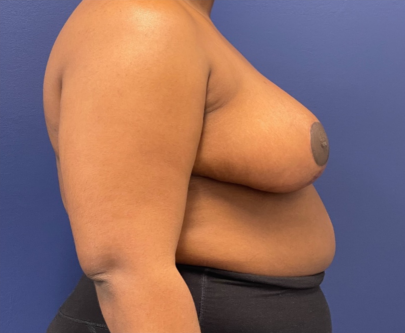 Breast-Reduction-Case--240 | After Breast 2