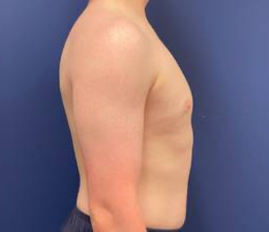 Gynecomastia-Case--214 | After Breast 2