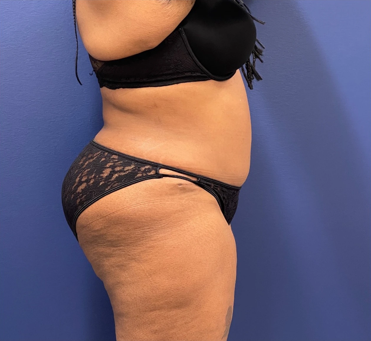 Lipoabdominoplasty-Case--245 | After Liposuction 2