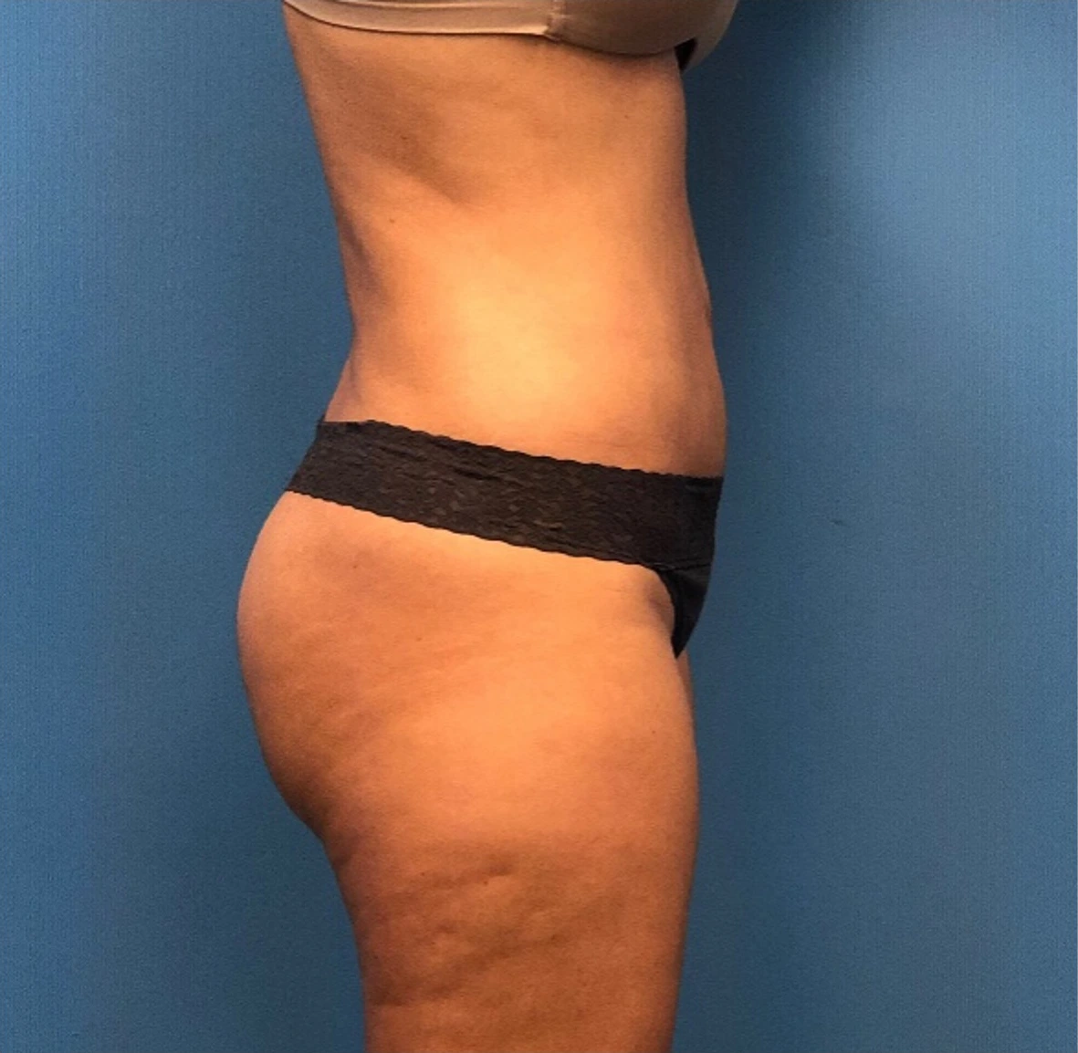 Lipo-360-Case--277 | After Liposuction 2