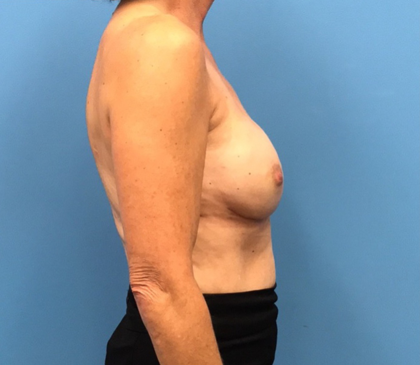 Breast-Reconstruction-Case--309 | After Breast 2