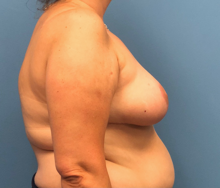 Breast-Reduction-Case--13597 | After Breast 2