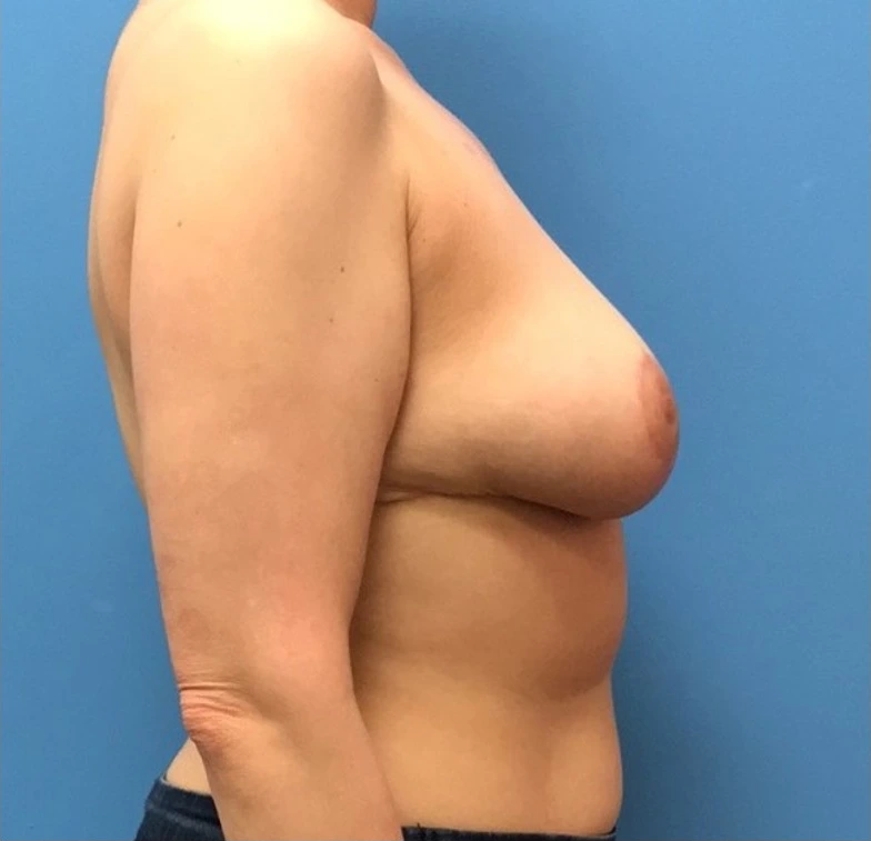 Breast-Reduction-Case--242 | After Breast 2