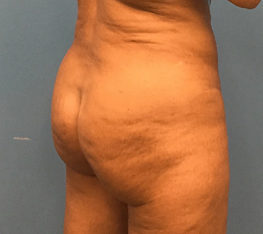 Brazilian-Butt-Lift-Case--74 | After Brazilian Butt Lift 2