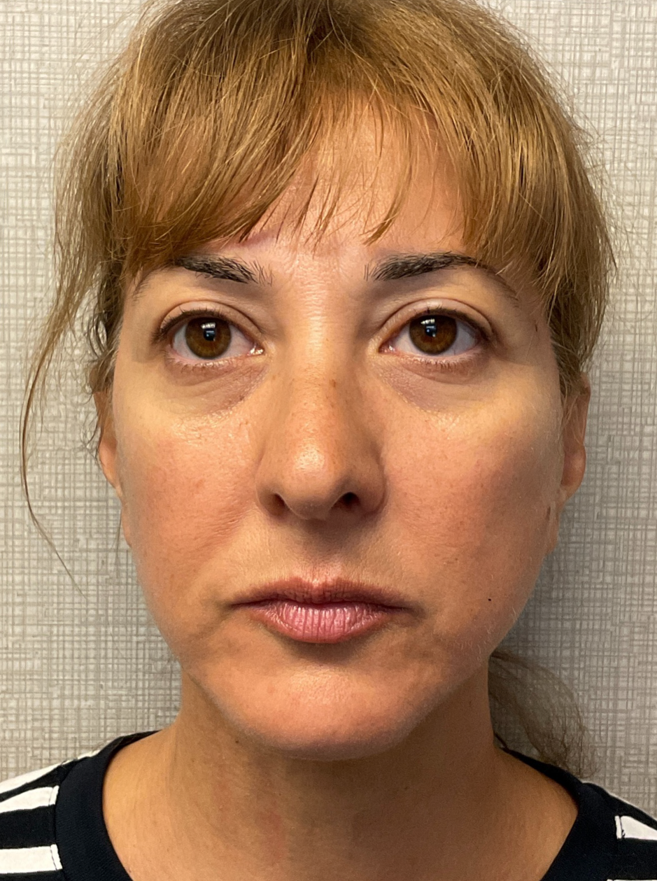Facelift-360-Facial-Fat-Graft-Blepharoplasty-Neck-Lift-Case--6190 | After Face360 1