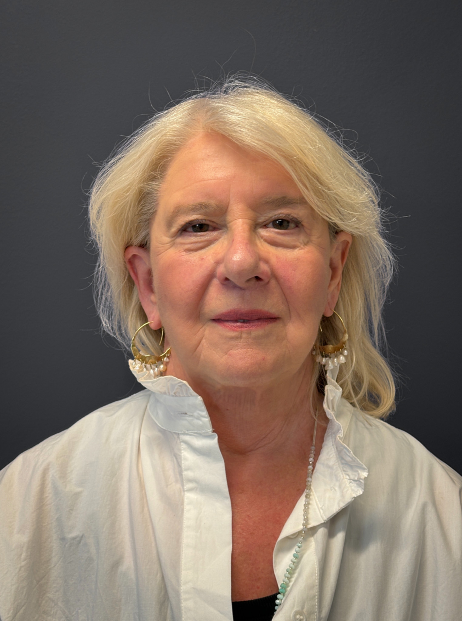 Facelift-360-Facial-Fat-Grafting-and-Necklift-Blepharoplasty-Case--1088 | After Facelift 1