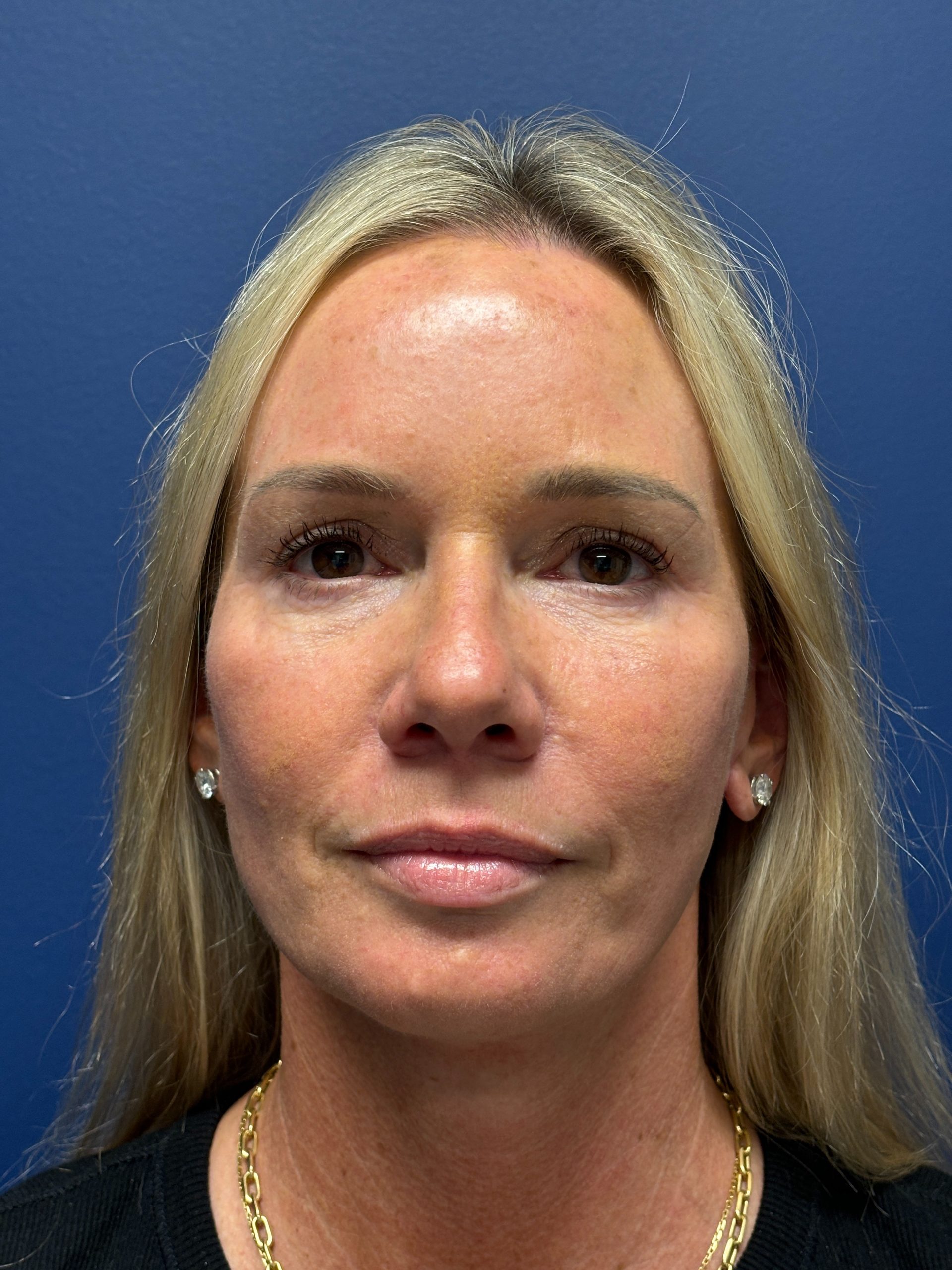 Facelift-Facial-Fat-Grafting-Necklift-Blepharoplasty-Case--9823 | After Facelift 1