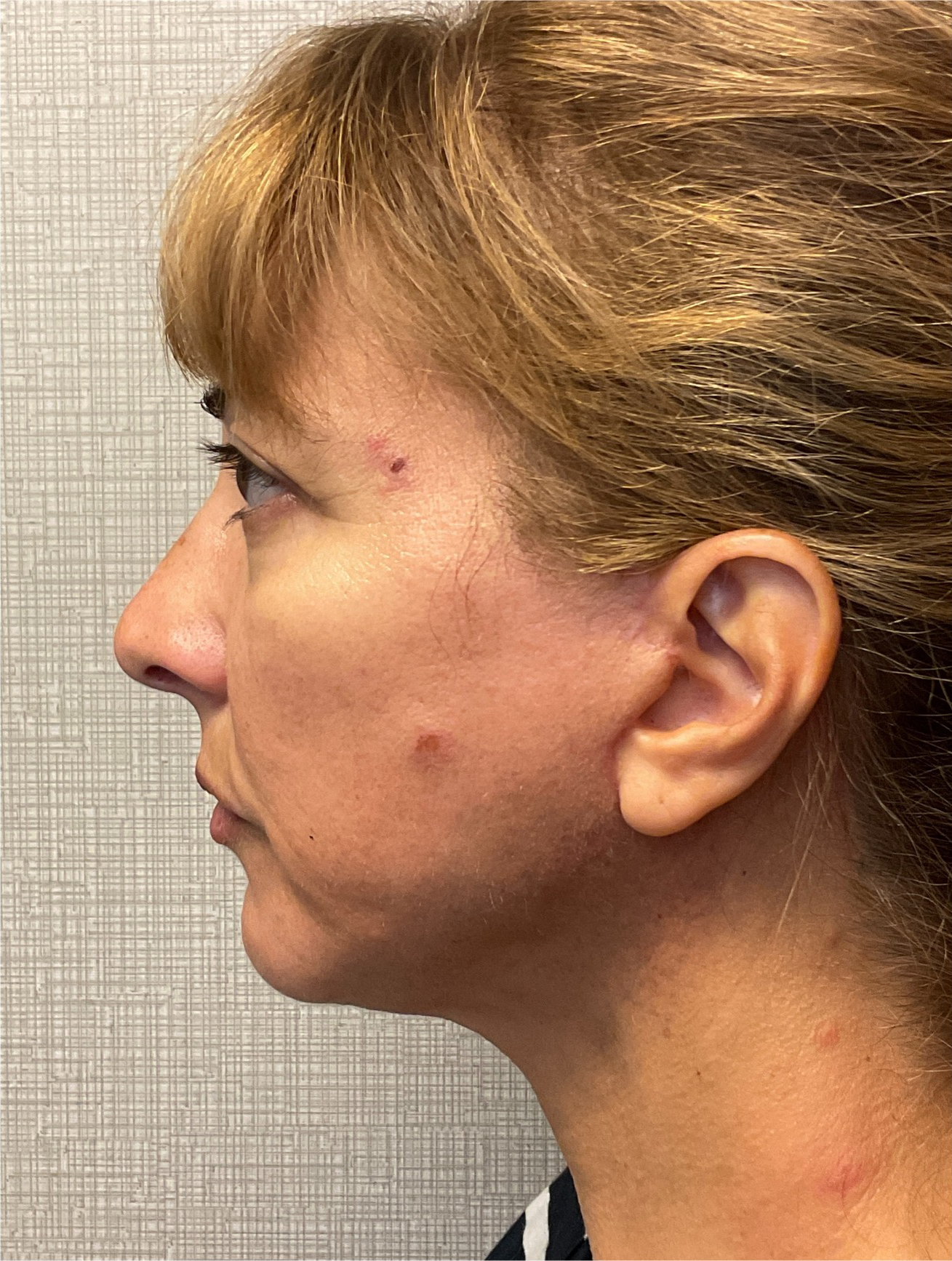 Facelift-360-Facial-Fat-Graft-Blepharoplasty-Neck-Lift-Case--6190 | After Face360 2