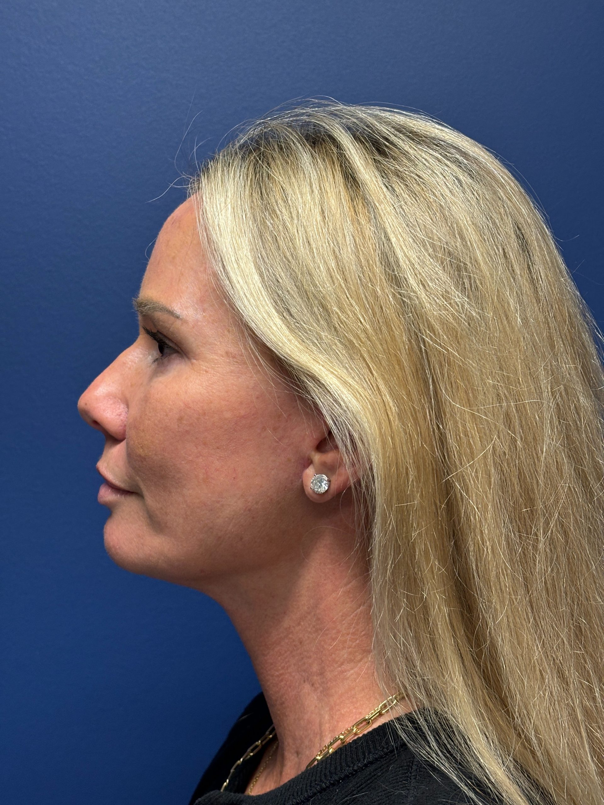 Facelift-Facial-Fat-Grafting-Necklift-Blepharoplasty-Case--9823 | After Facelift 2