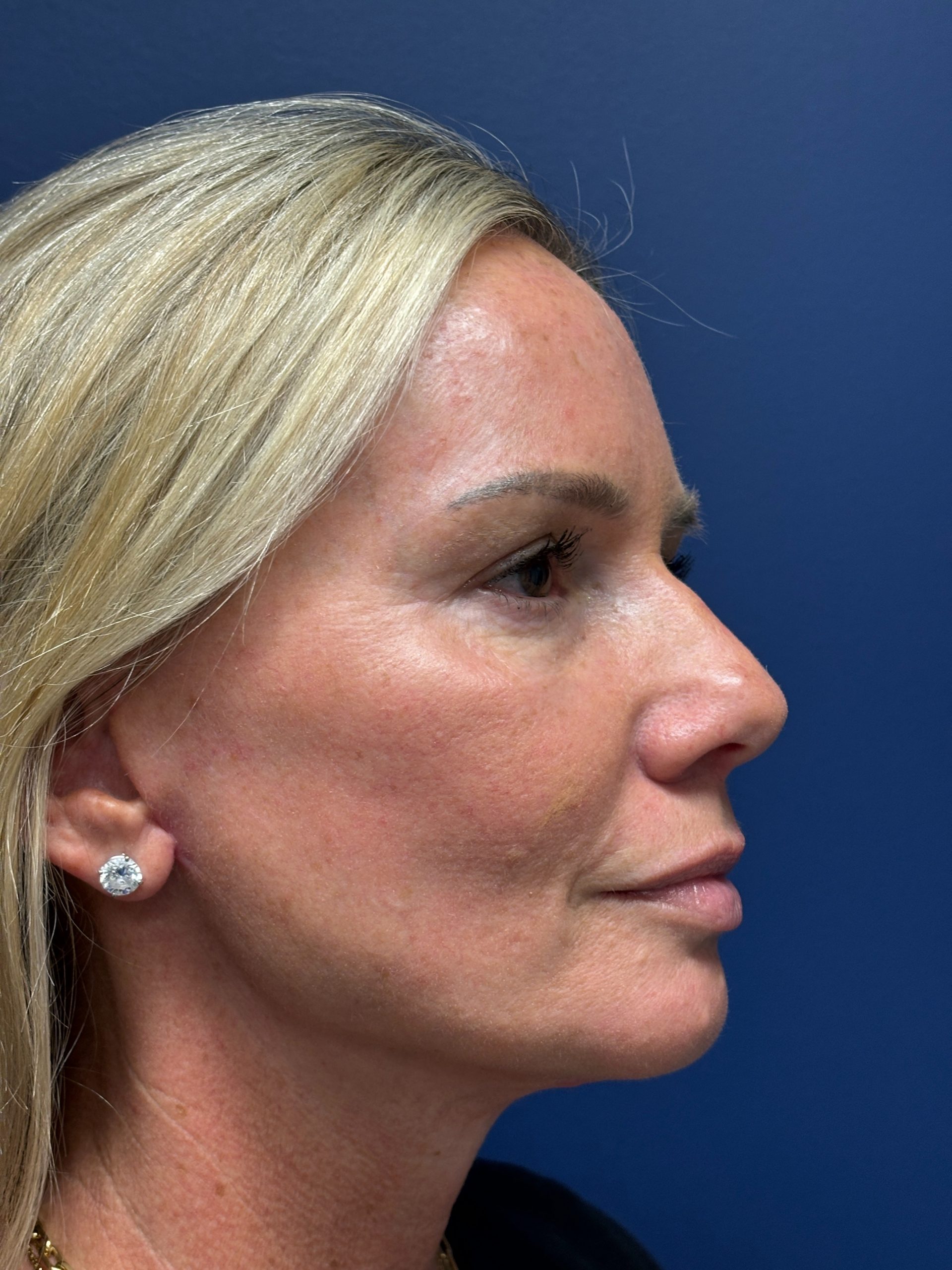 Facelift-Facial-Fat-Grafting-Necklift-Blepharoplasty-Case--9823 | After Eyelid Surgery 3