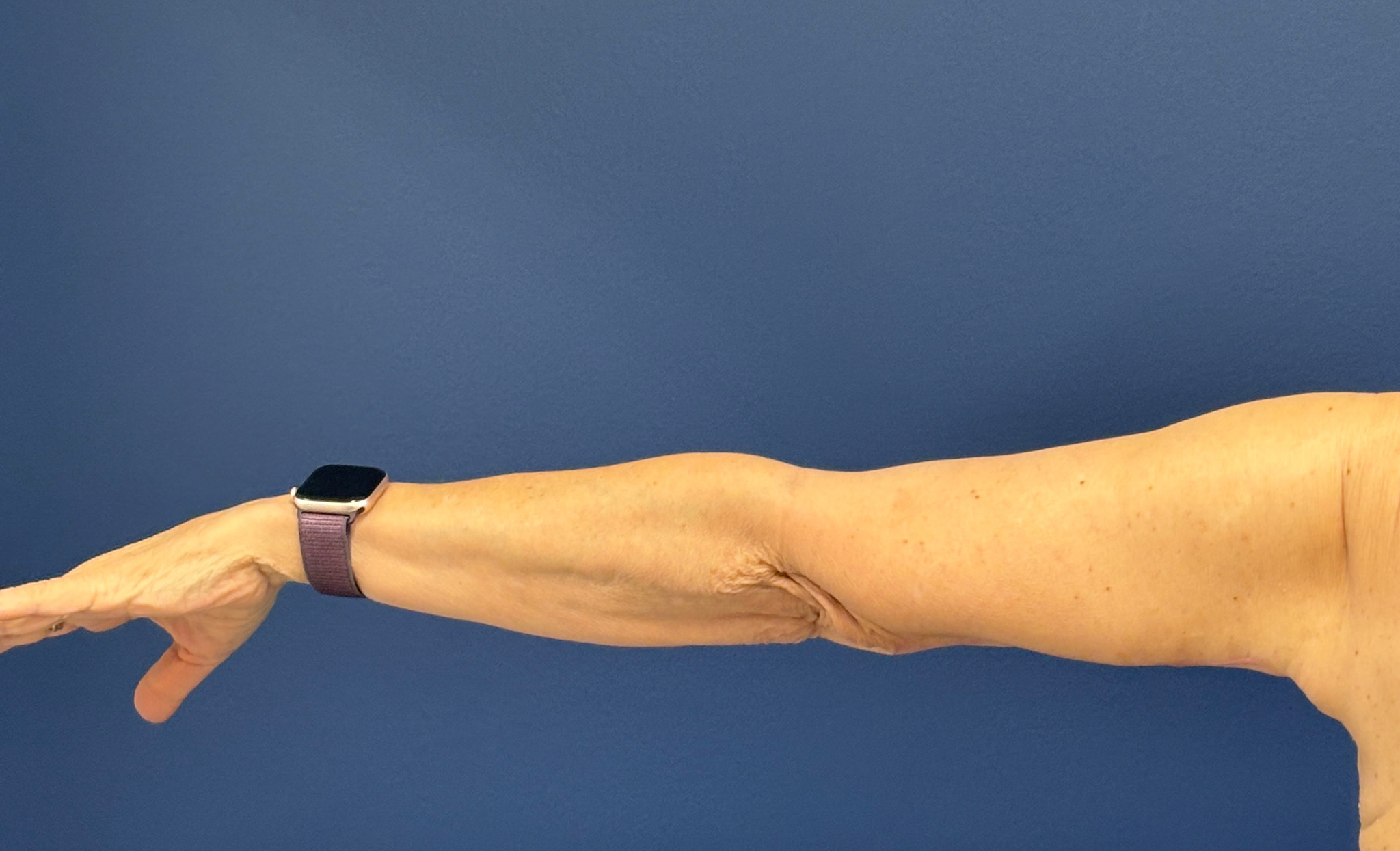 Brachioplasty-Case--3625 | After Arm Lift 8
