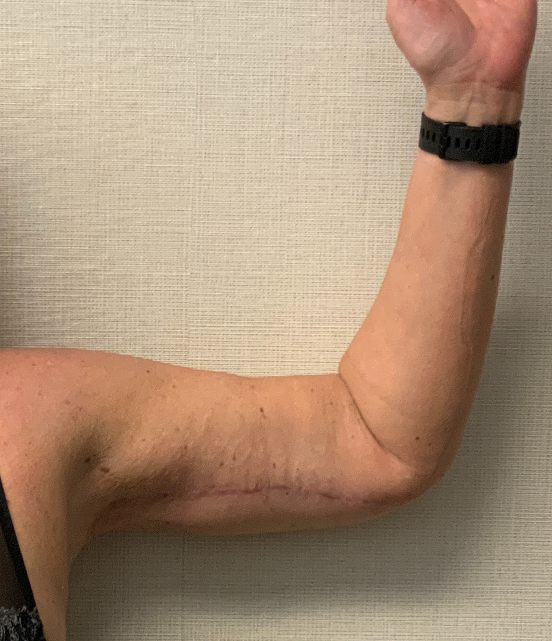 Brachioplasty-Case--3168 | After Arm Lift 2