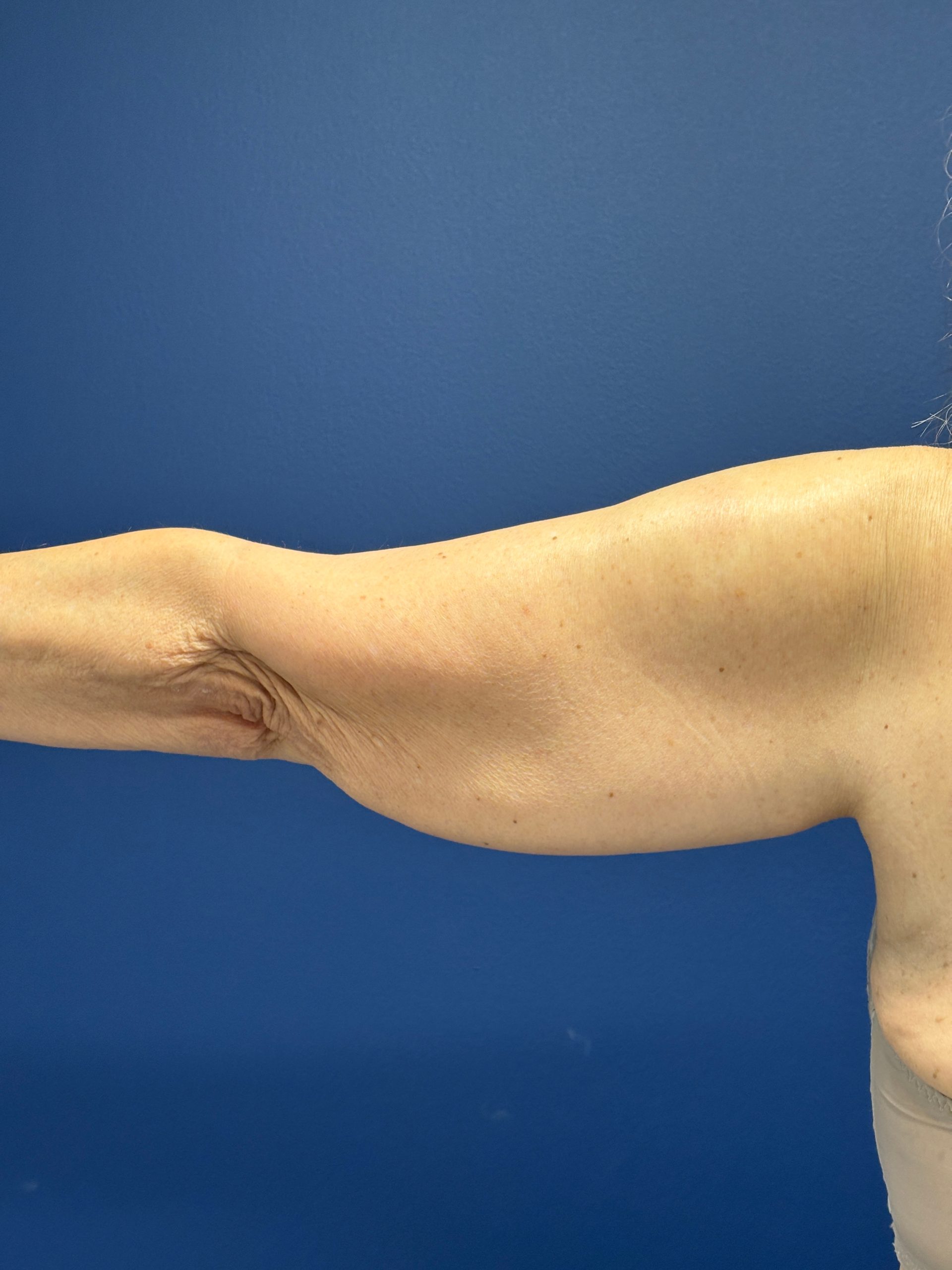 Brachioplasty-Case--3625 | Before Arm Lift 8