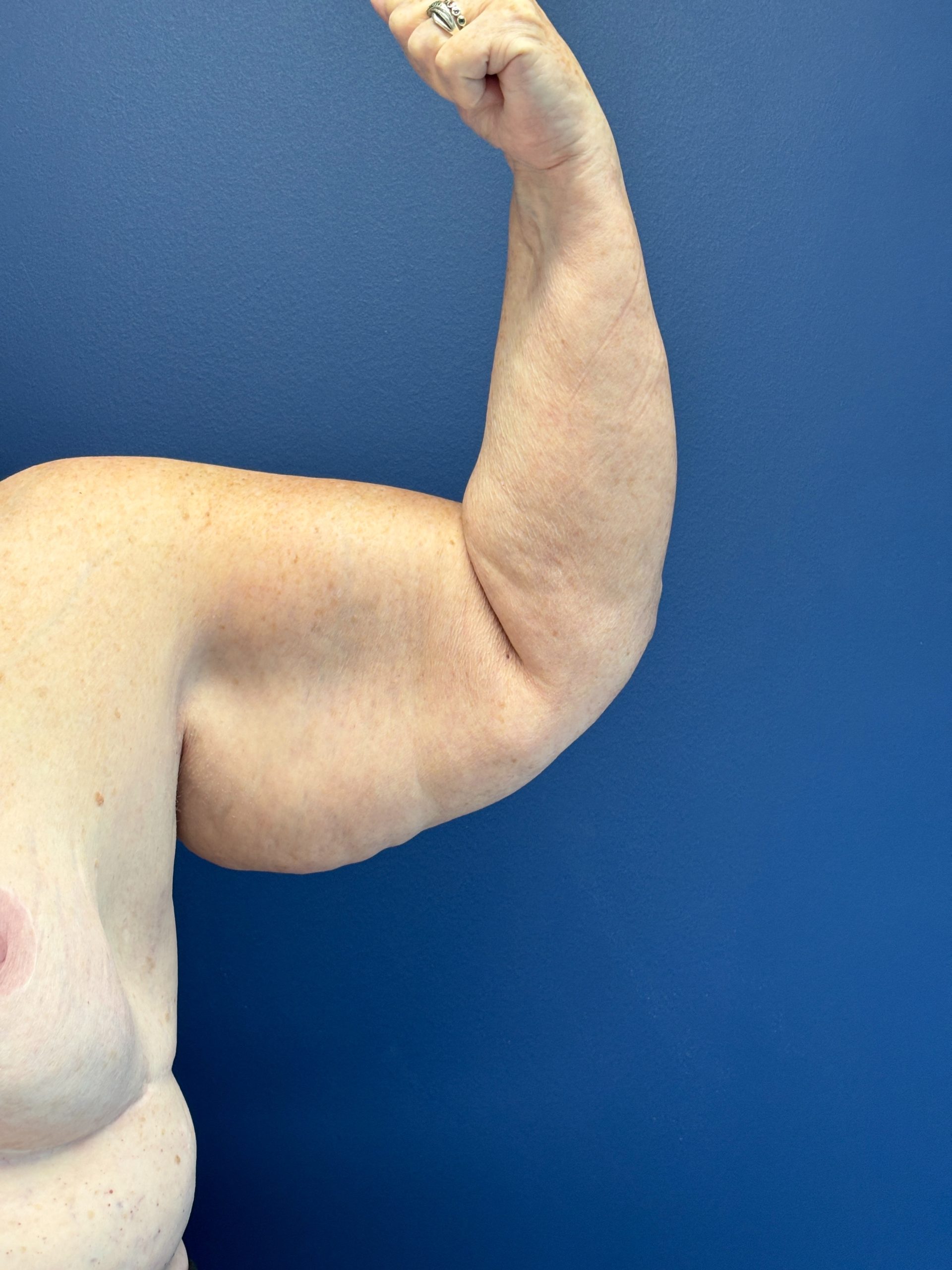 Brachioplasty-Case--3447 | Before Arm Lift 5