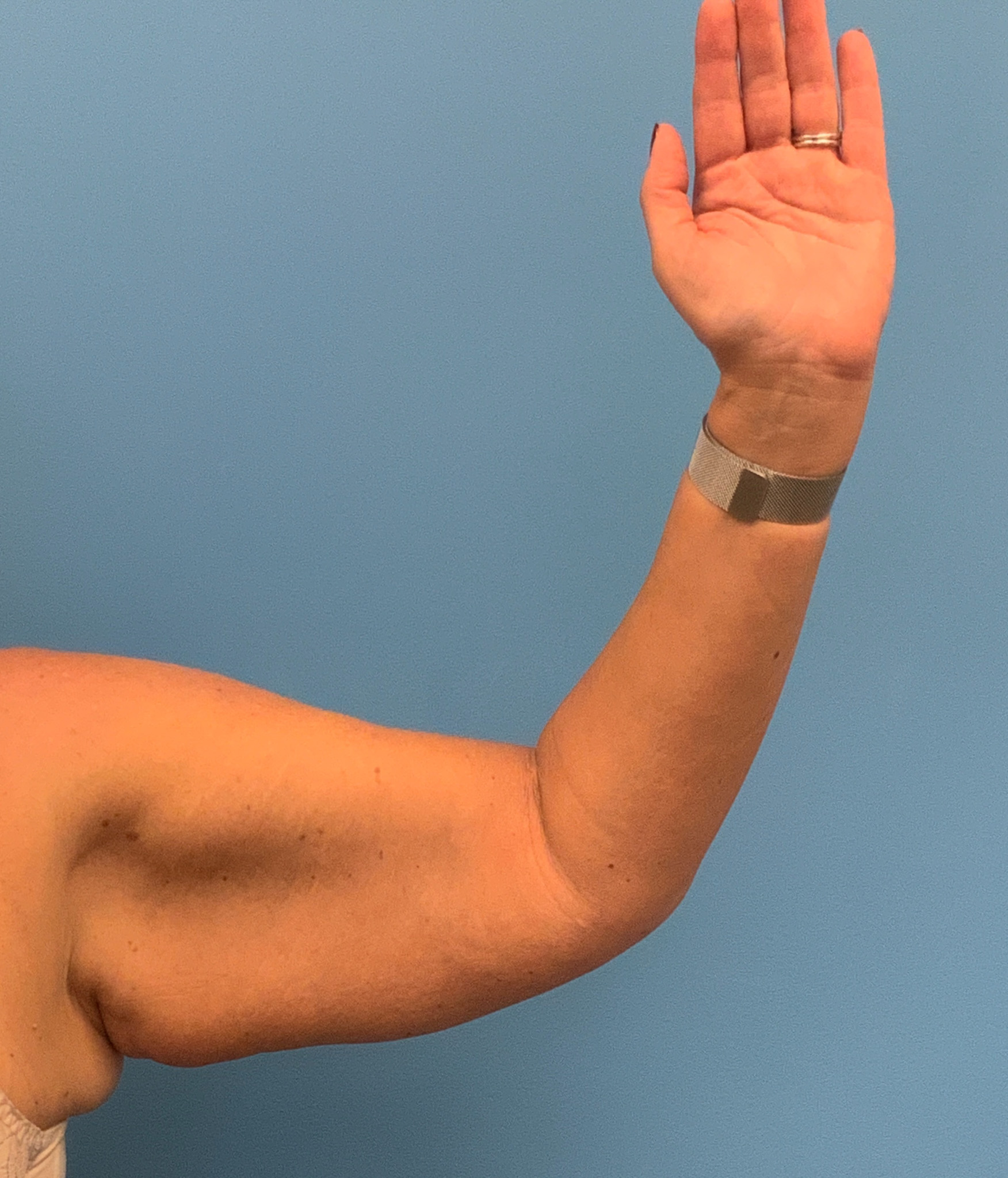 Brachioplasty-Case--3168 | Before Arm Lift 2