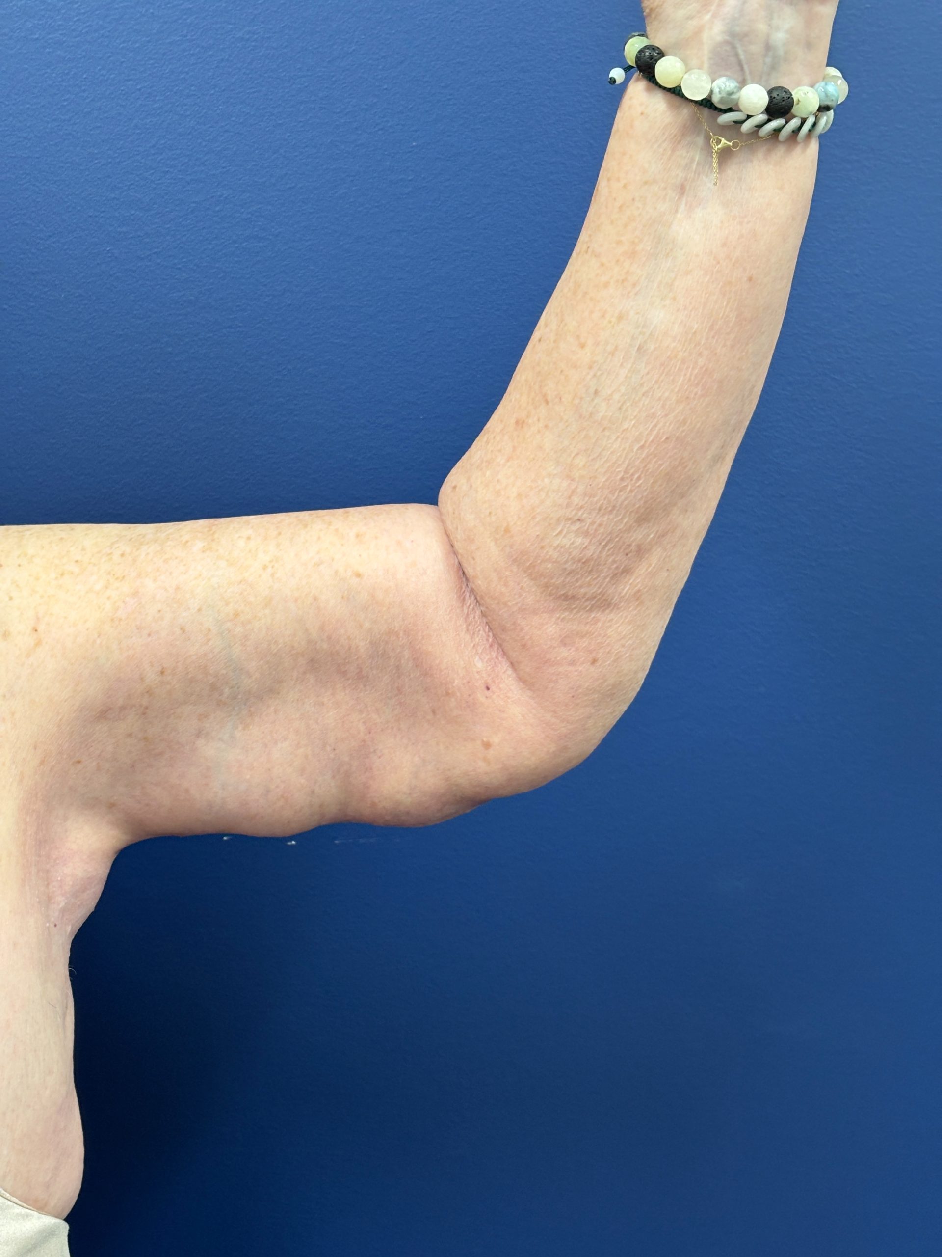 Brachioplasty-Case--3447 | After Arm Lift 5
