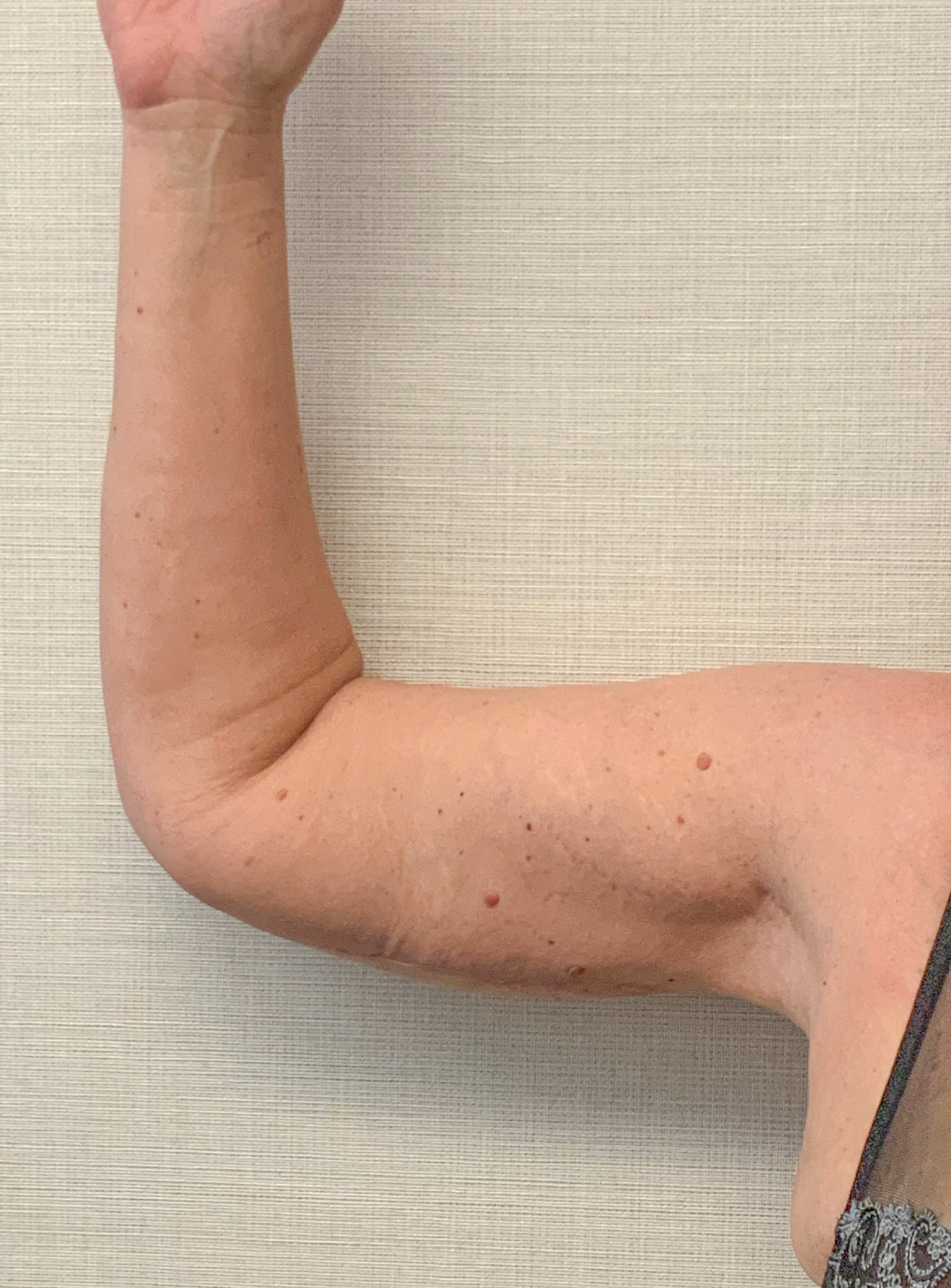 Brachioplasty-Case--3168 | After Arm Lift 1