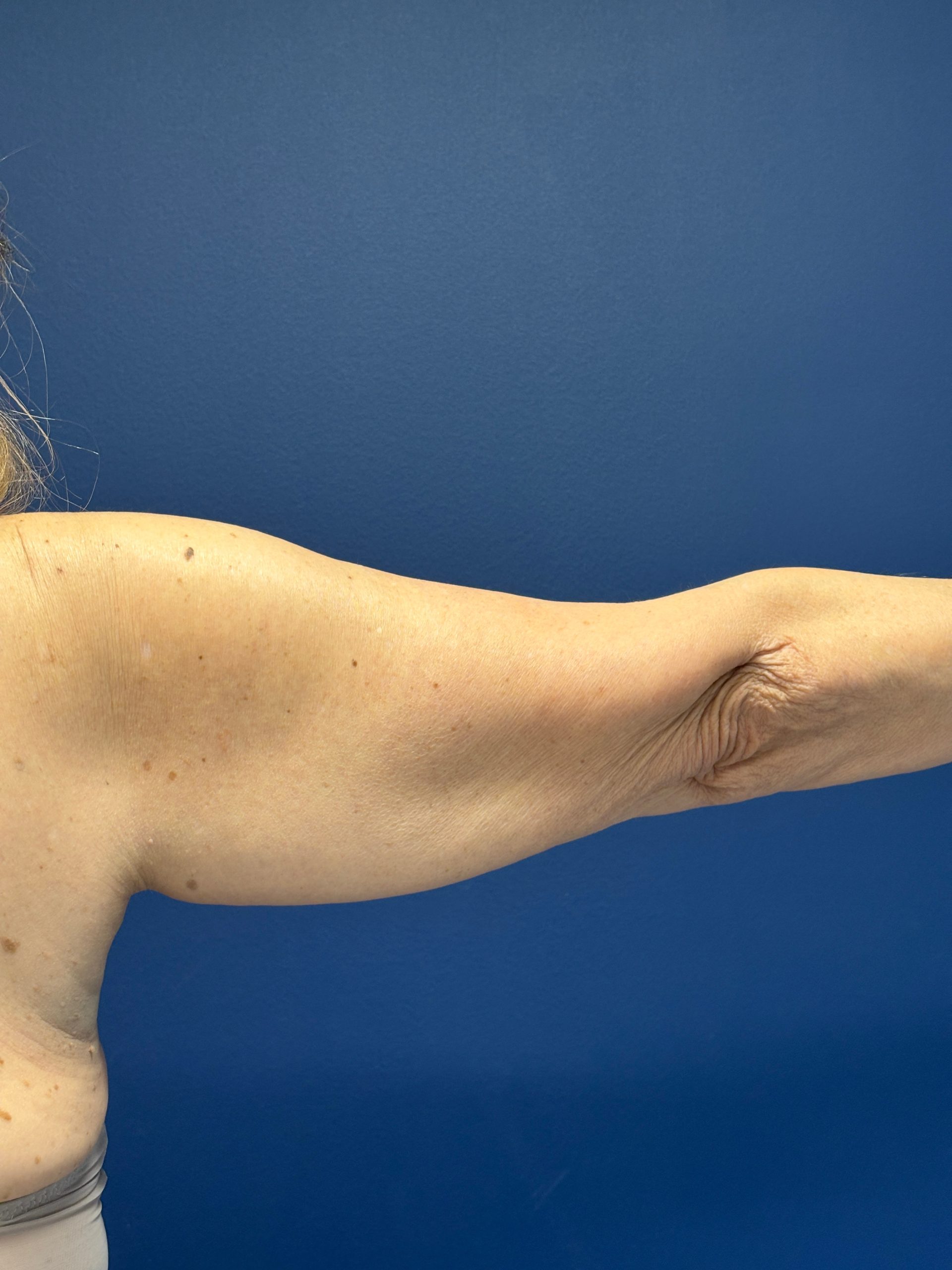 Brachioplasty-Case--3625 | Before Arm Lift 7