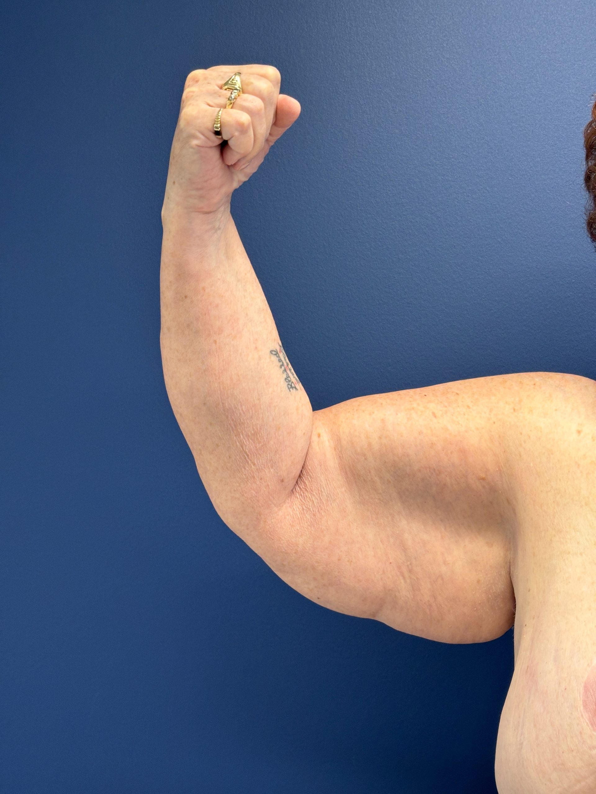 Brachioplasty-Case--3447 | Before Arm Lift 6