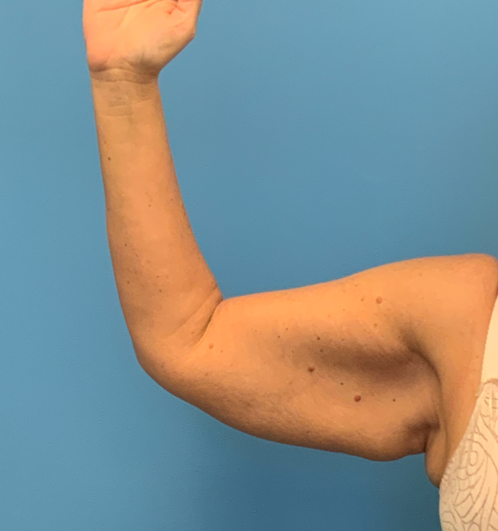 Brachioplasty-Case--3168 | Before Arm Lift 1