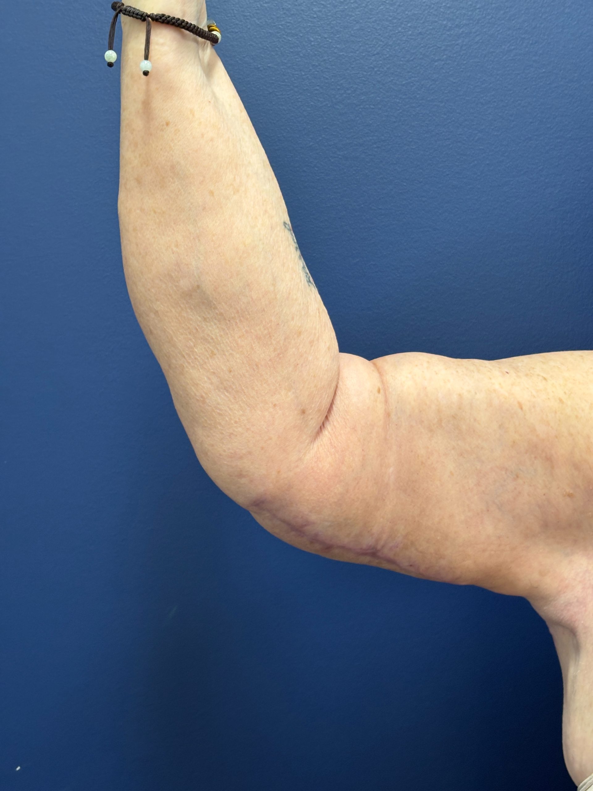 Brachioplasty-Case--3447 | After Arm Lift 6