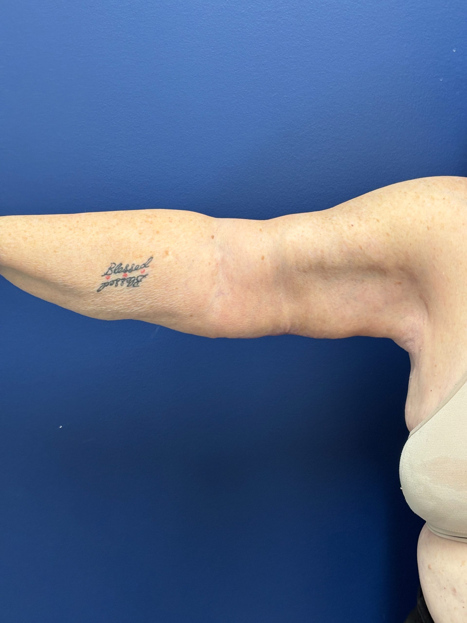 Brachioplasty-Case--3447 | After Dr. Frank Albino 2