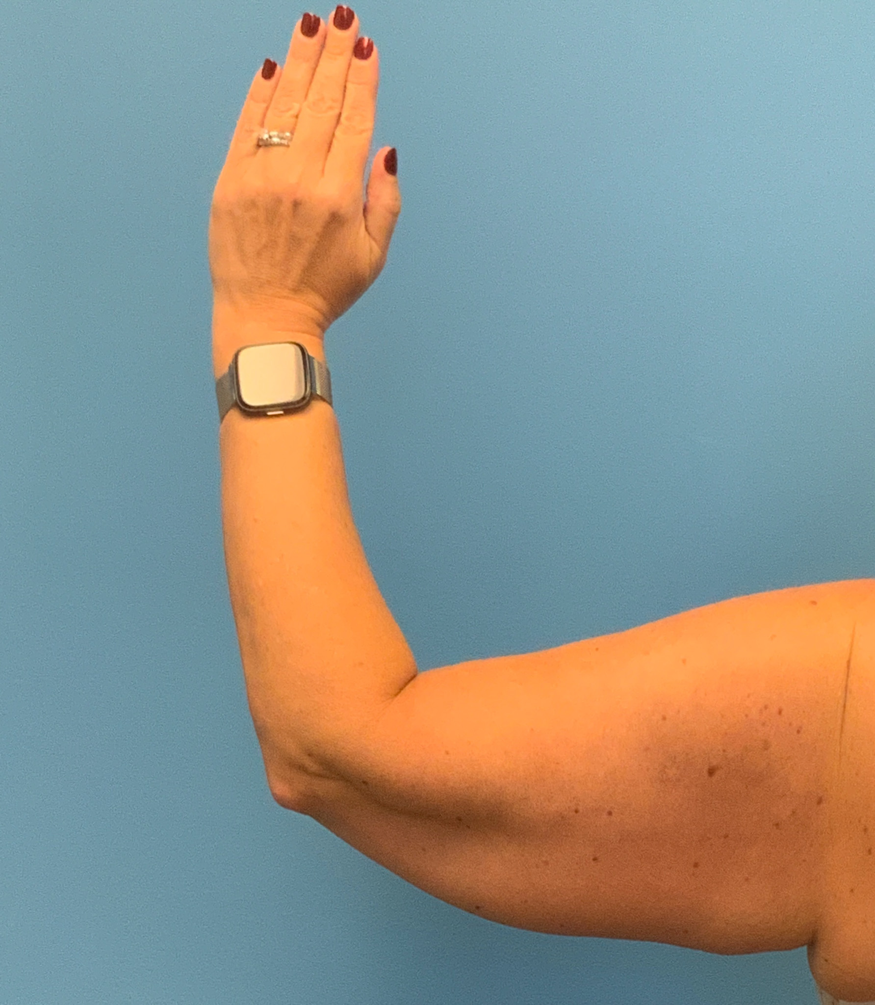 Brachioplasty-Case--3168 | Before Arm Lift 3