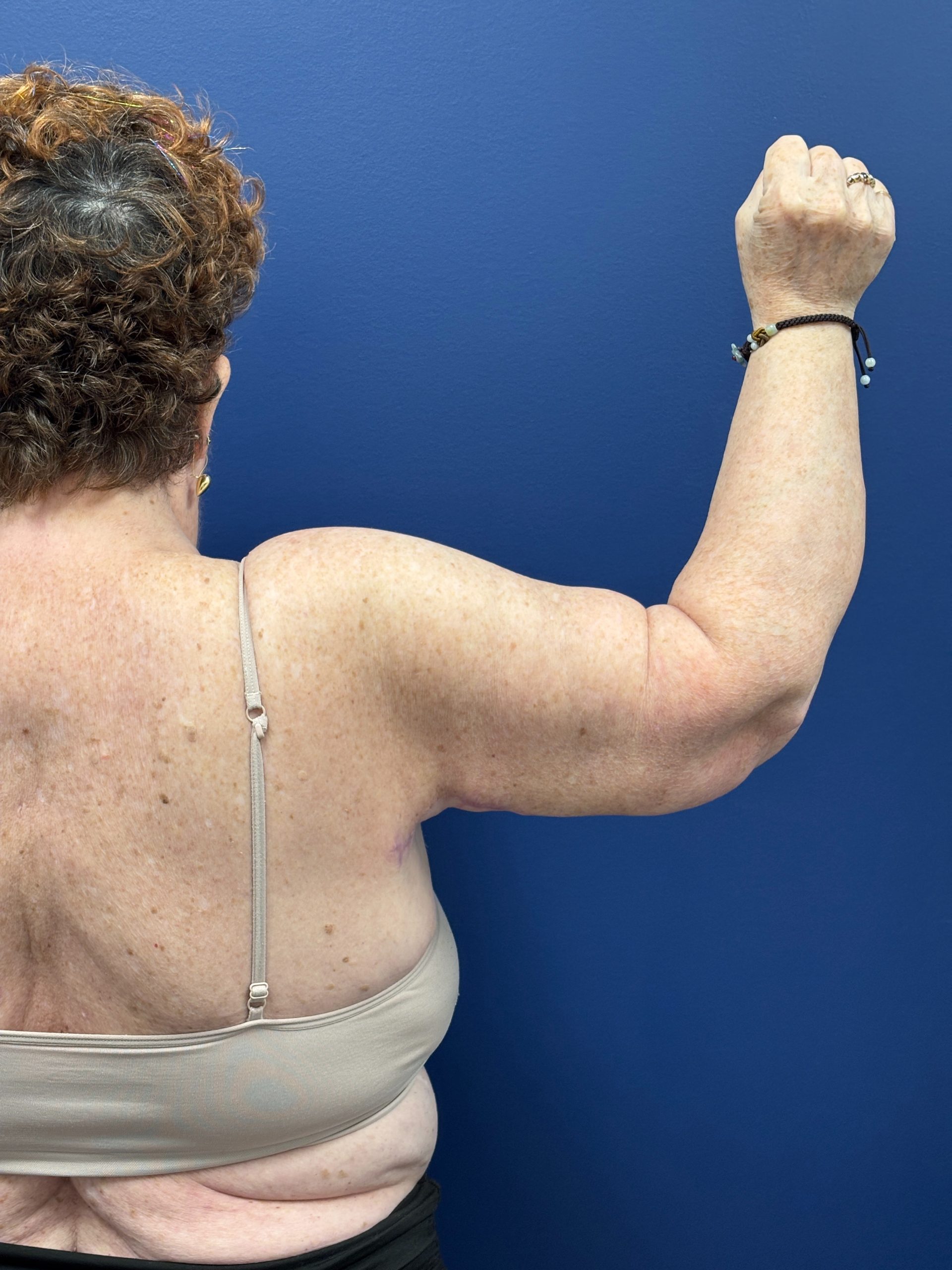 Brachioplasty-Case--3447 | After Arm Lift 7