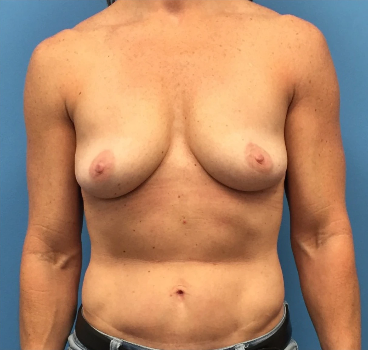 Breast-Augmentation-Mastopexy-Case--230 | Before Breast 1