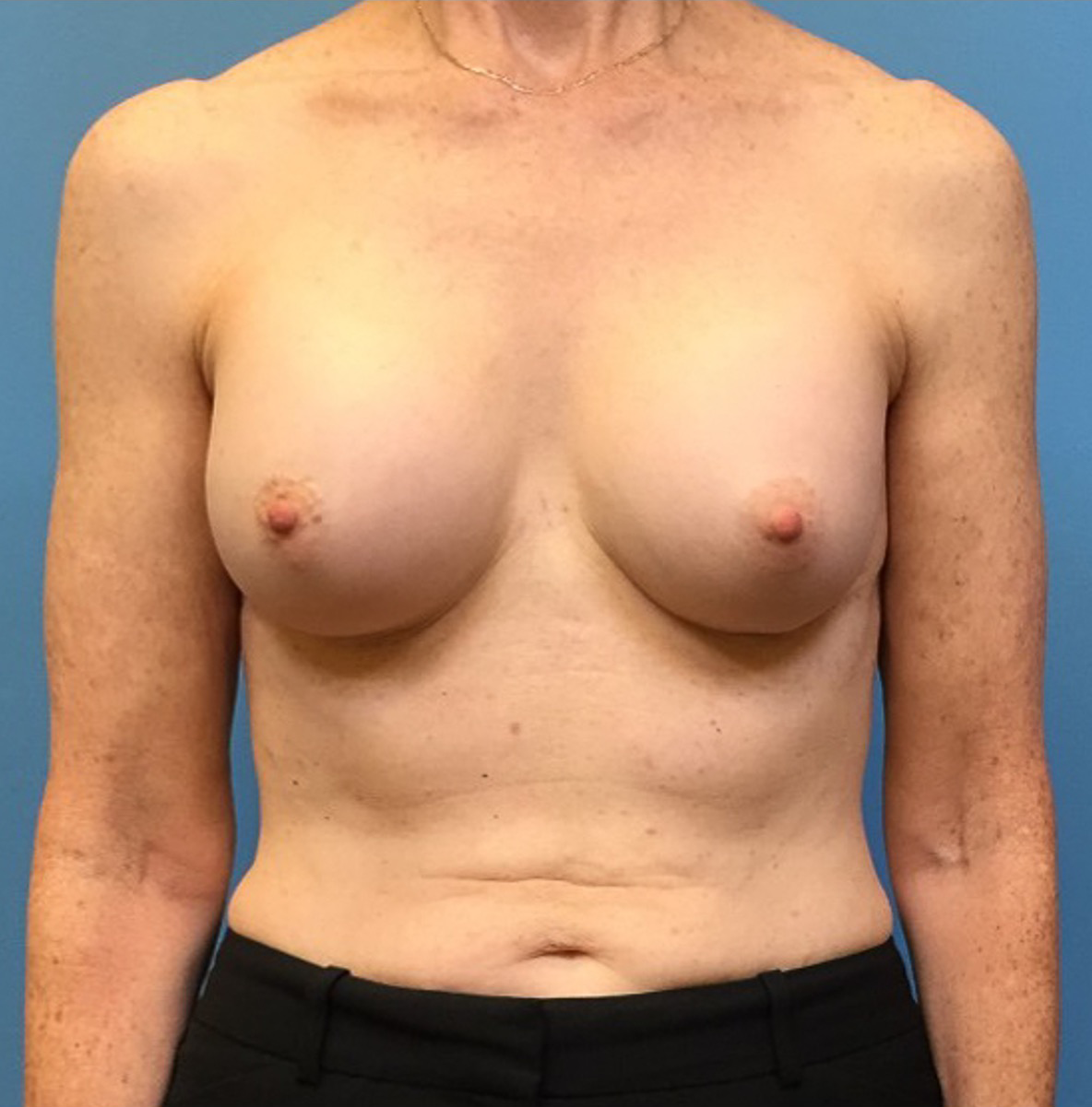 Revision-Augmentation-Case--236 | Before Breast 1