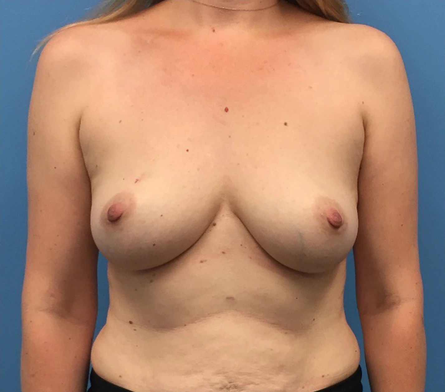Breast-Reconstruction-Case--295 | Before Breast 1