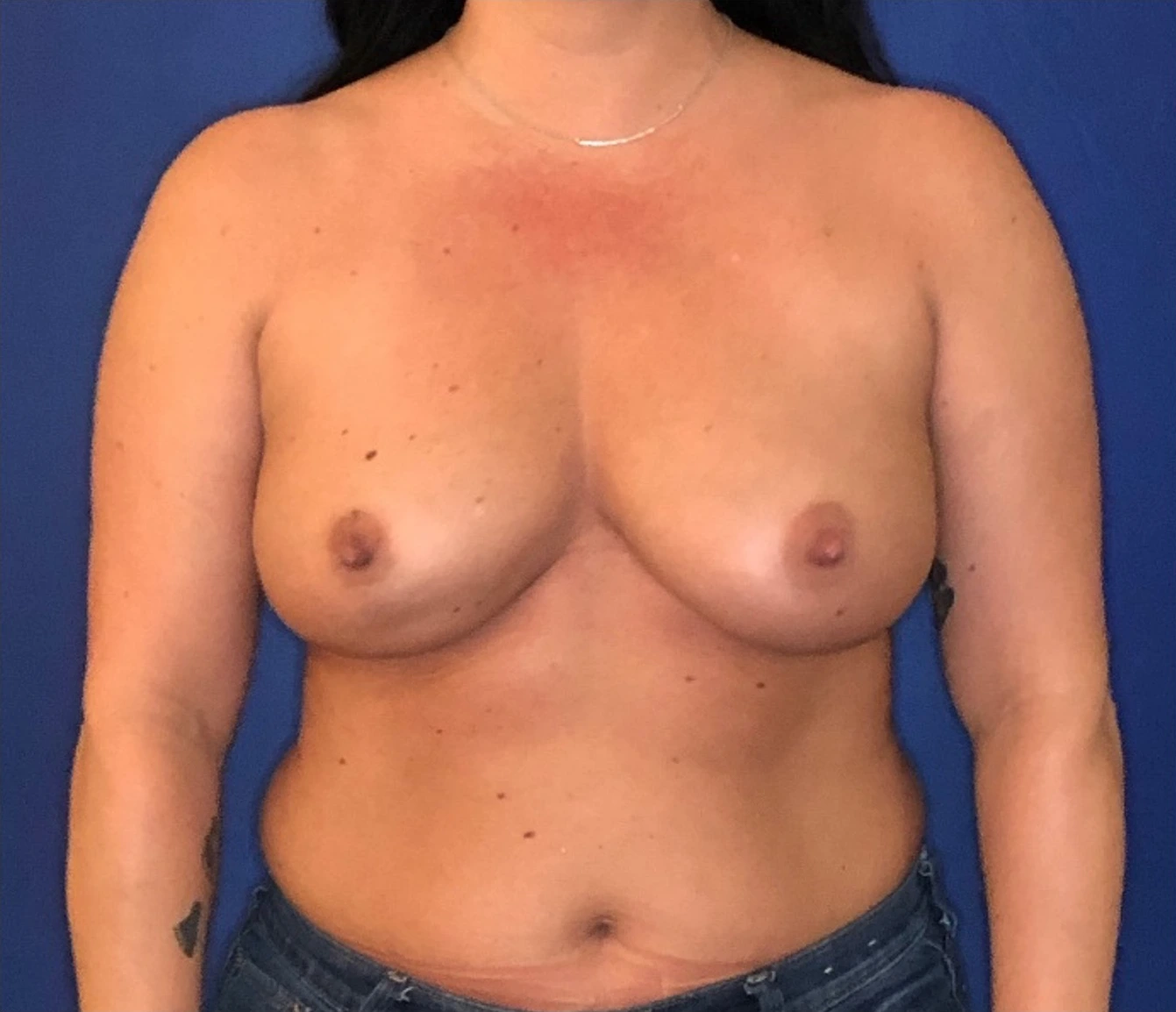 Breast-Reconstruction-Case--306 | Before Breast 1