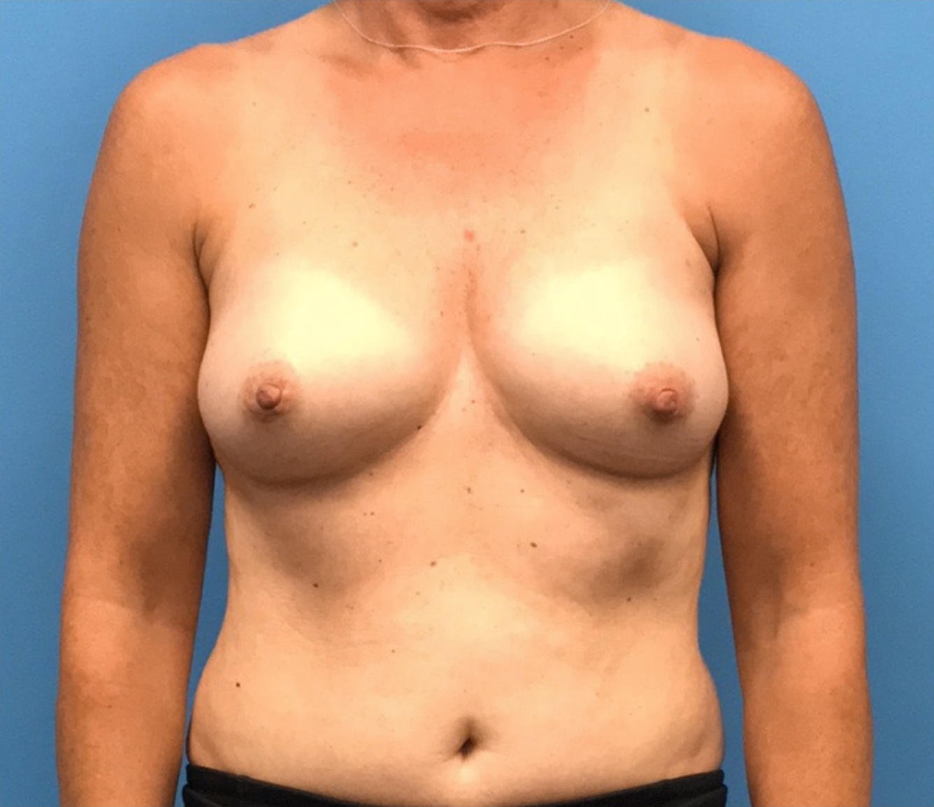 Breast-Reconstruction-Case--310 | Before Breast 1