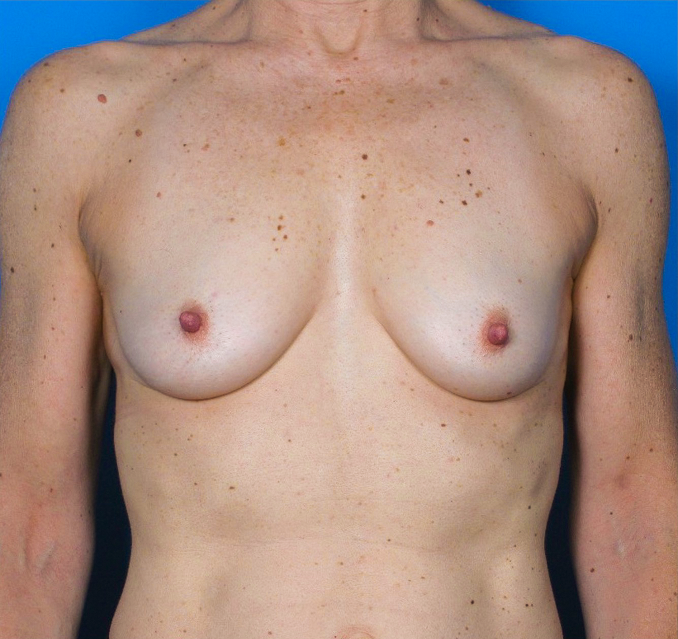 Breast-Reconstruction-Case--312 | Before Breast 1