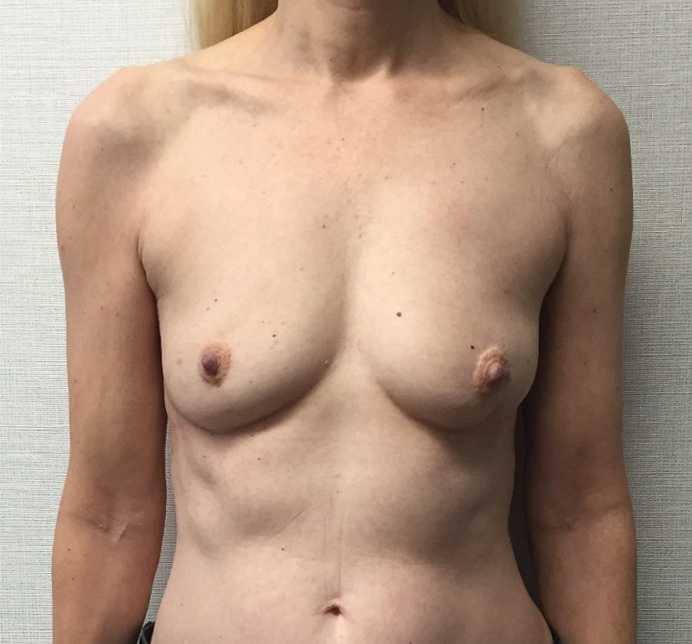 Breast-Reconstruction-Case--313 | Before Breast 1