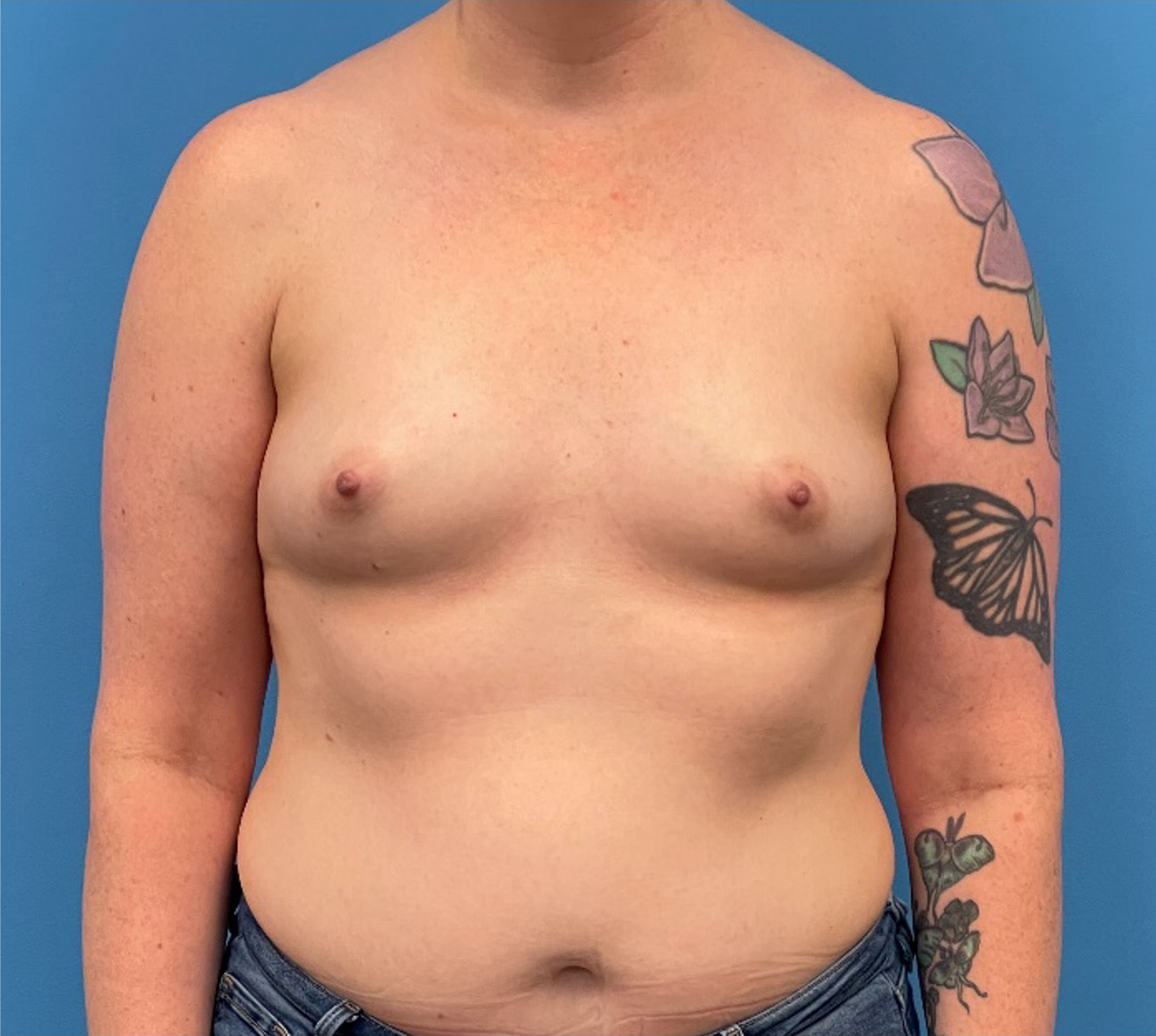 Breast-Reconstruction-Case--335 | Before Breast 1