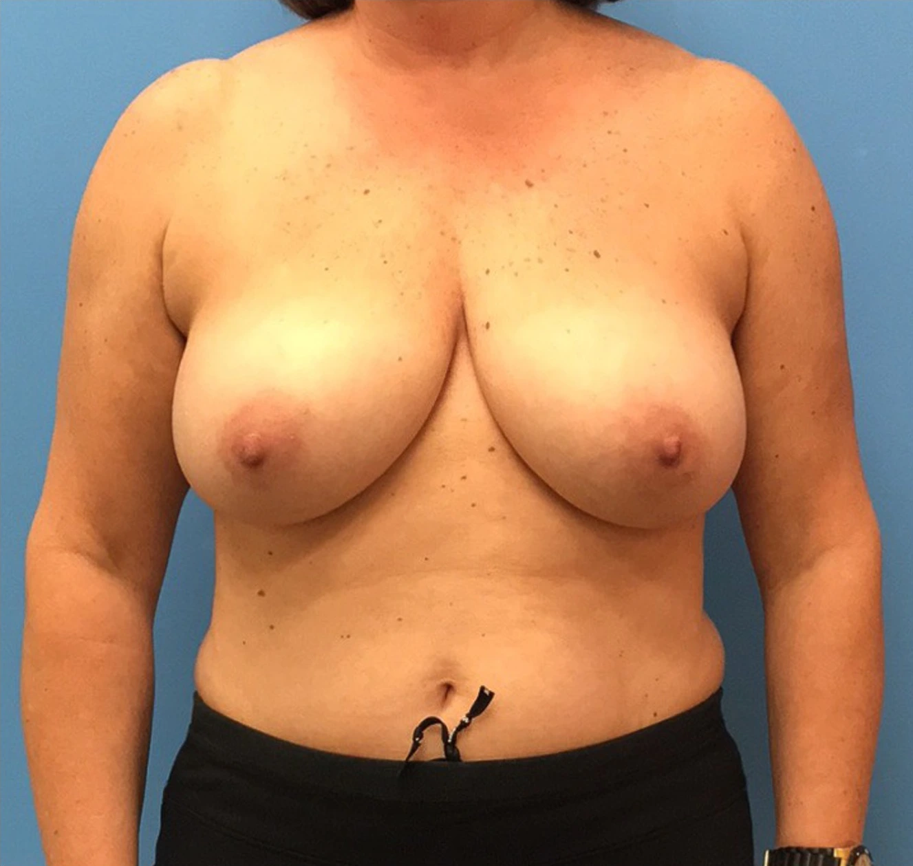 Case--314 | Before Breast 1