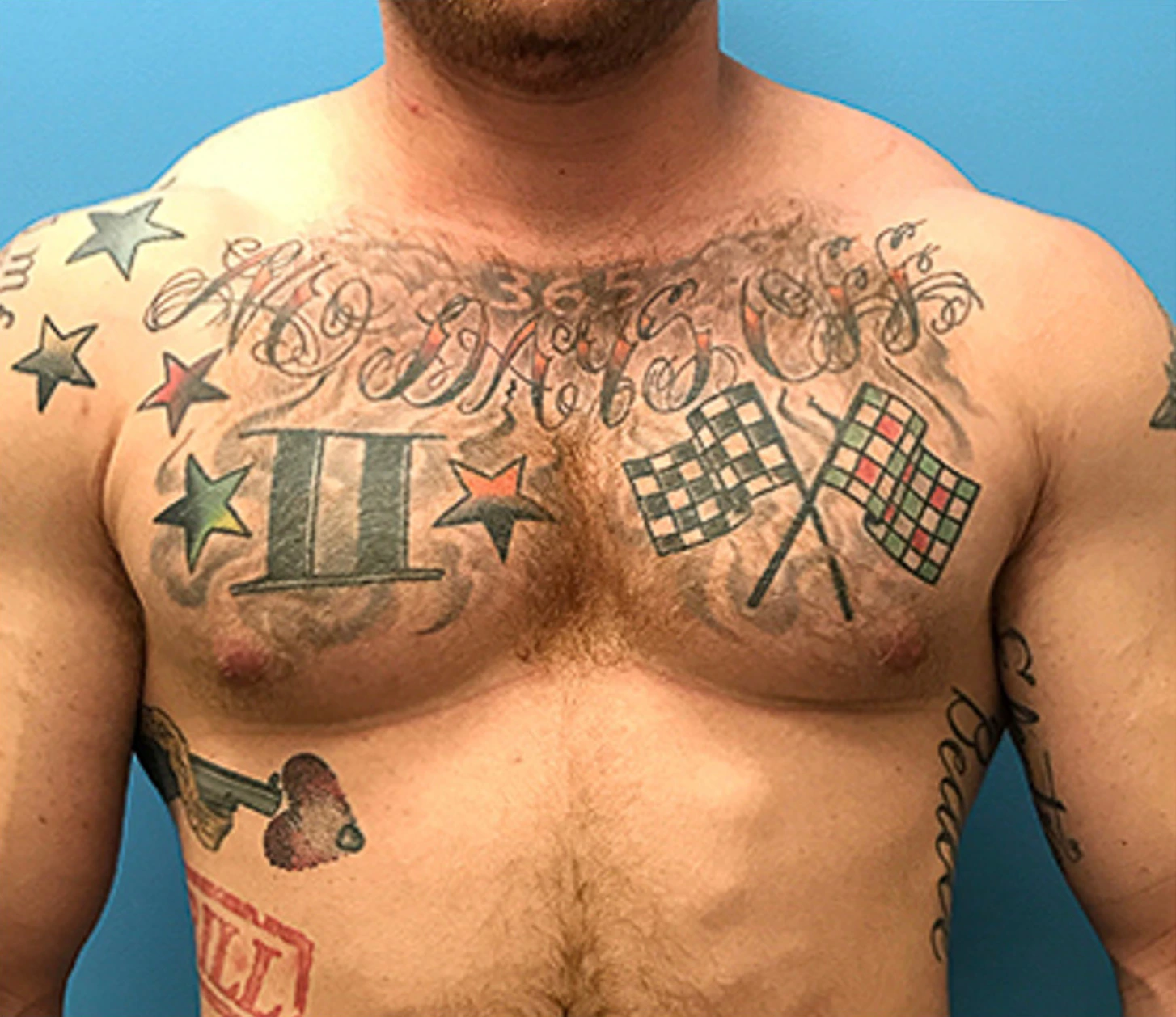 Gynecomastia-Case--143 | Before Breast 1