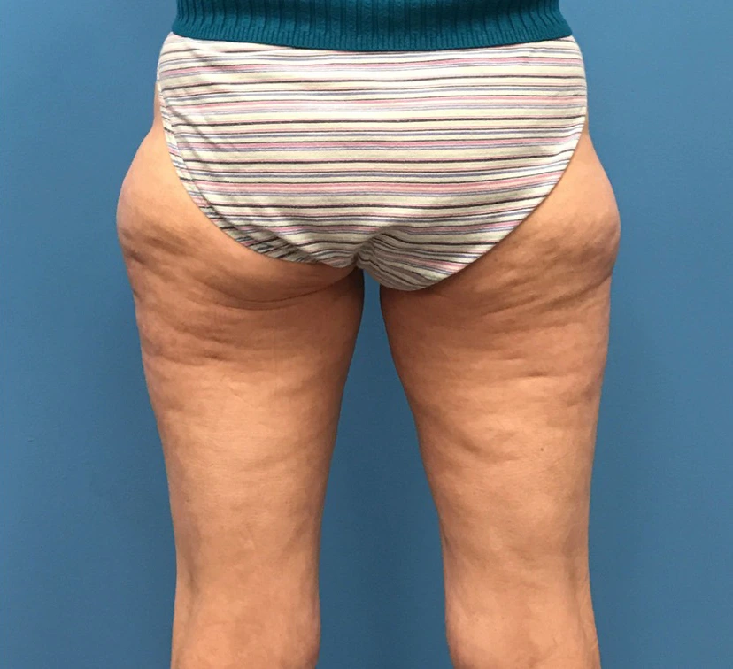 Case--10165 | Before Liposuction 1