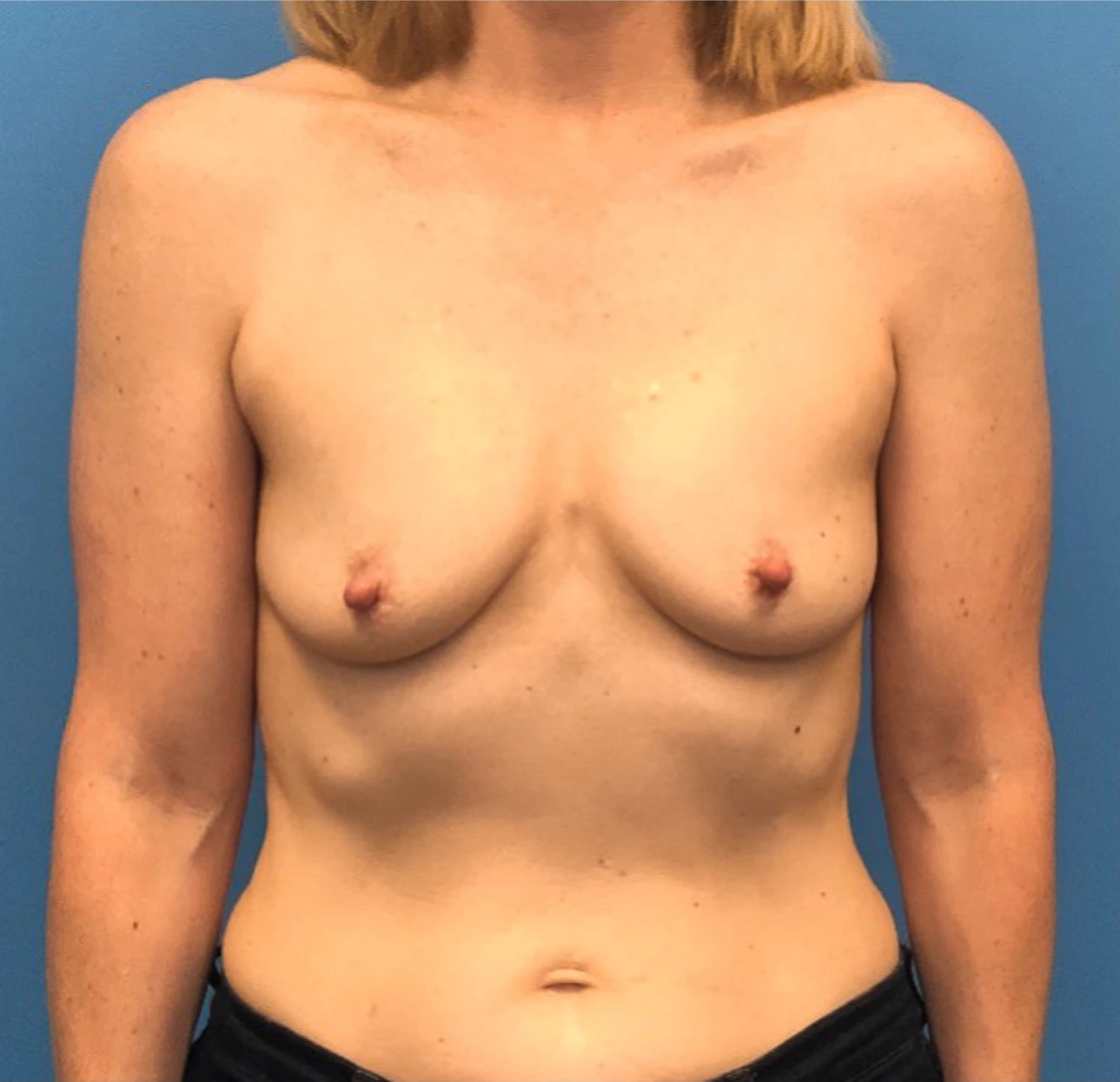 Case--301 | Before Breast 1