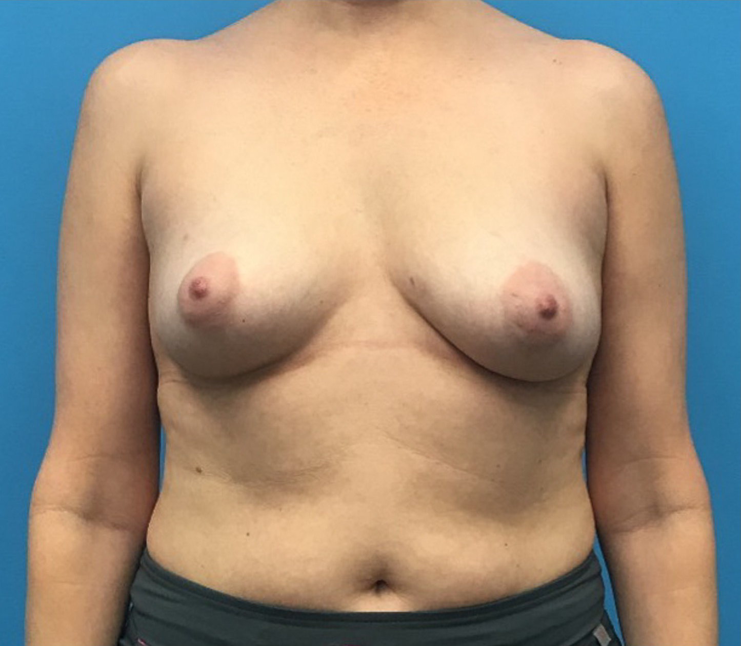Case--12659 | Before Breast 1