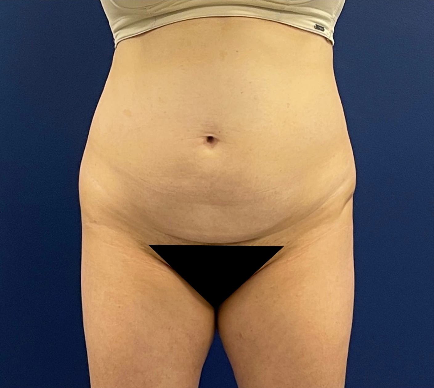 Abdominoplasty-Case--256 | Before Tummy Tuck 1