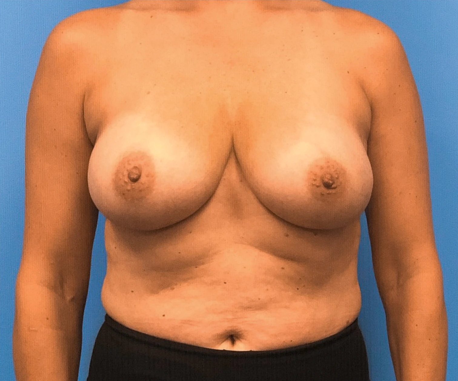 Breast-Reconstruction-Case--294 | Before Breast 1