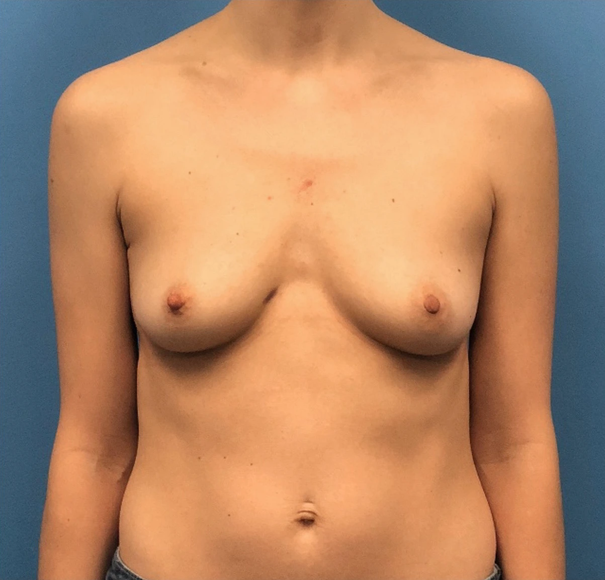 Breast-Reconstruction-Case--300 | Before Breast 1