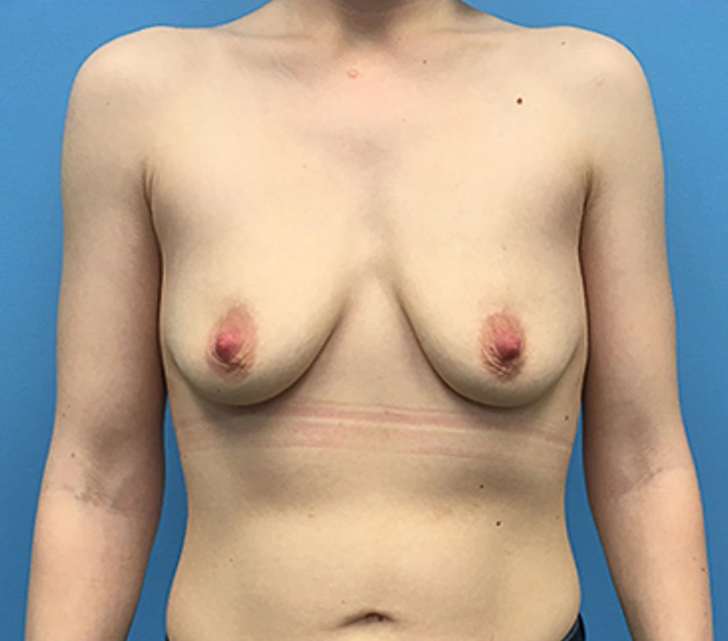 Breast-Augmentation-Case--93 | Before Breast 1