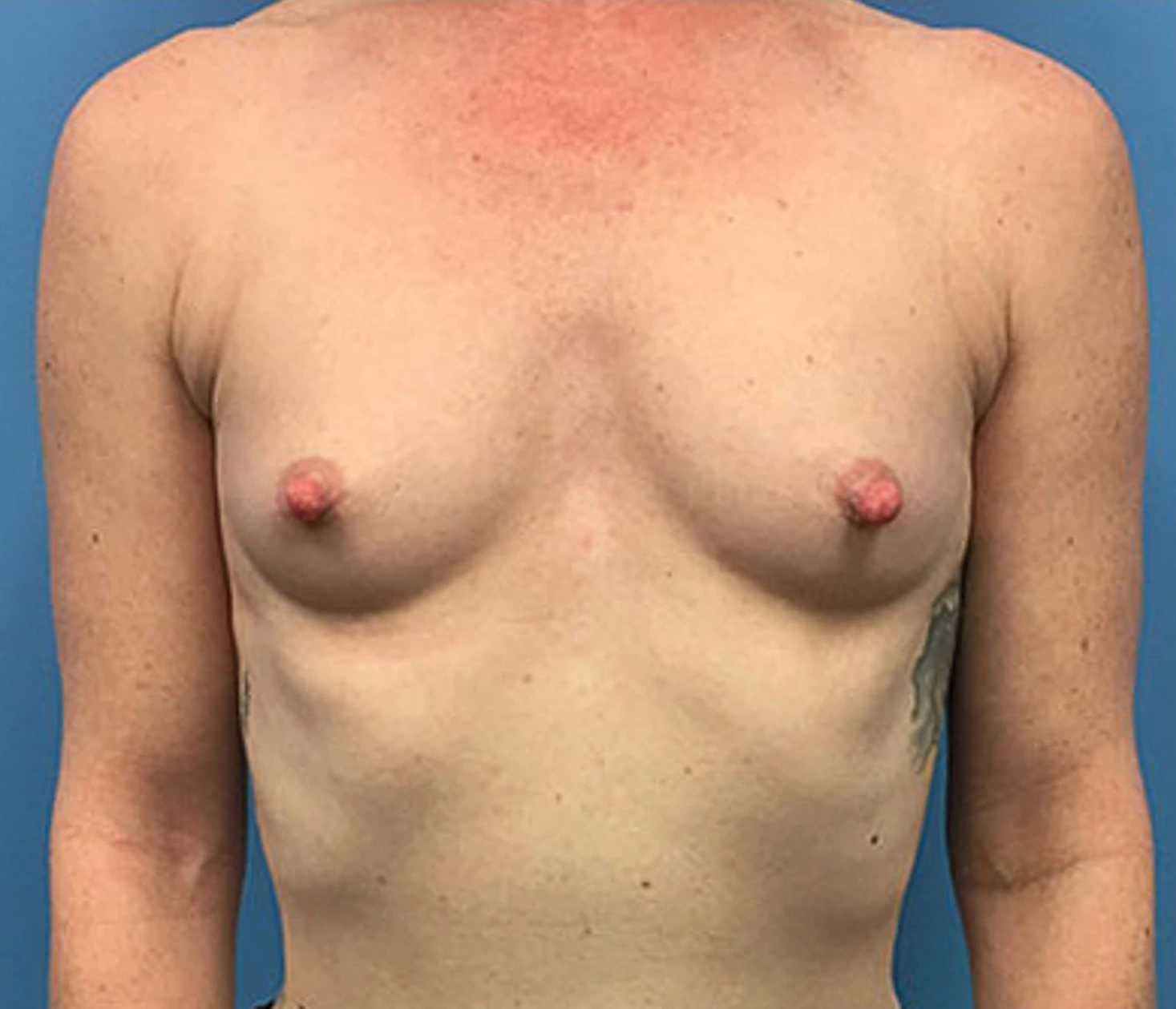 Case--88 | Before Breast 1